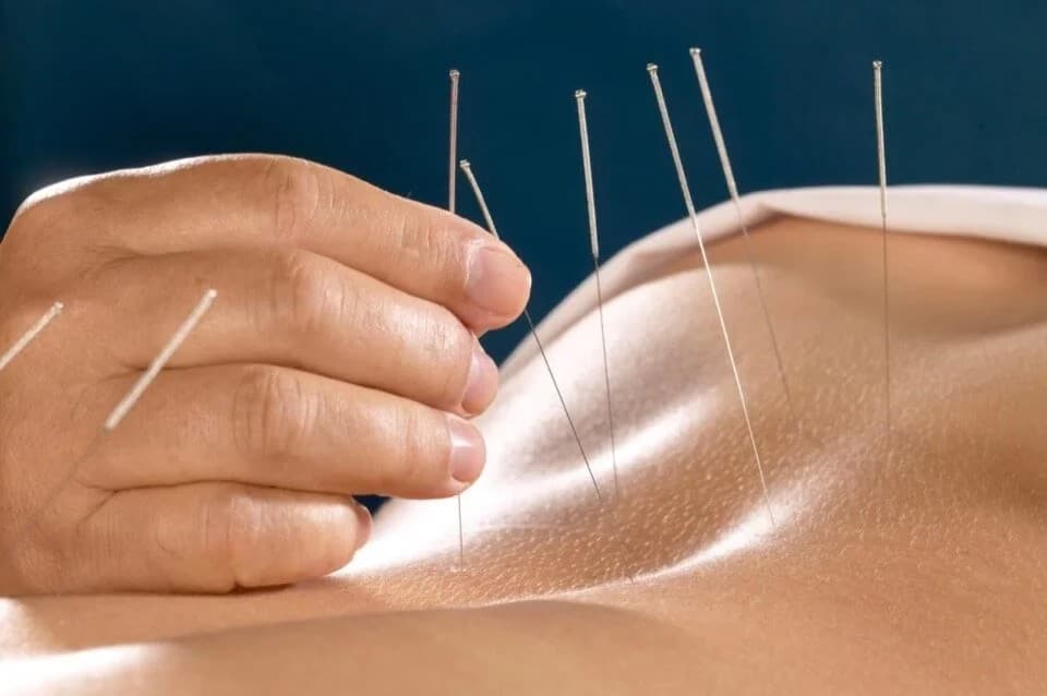 Akupunktur